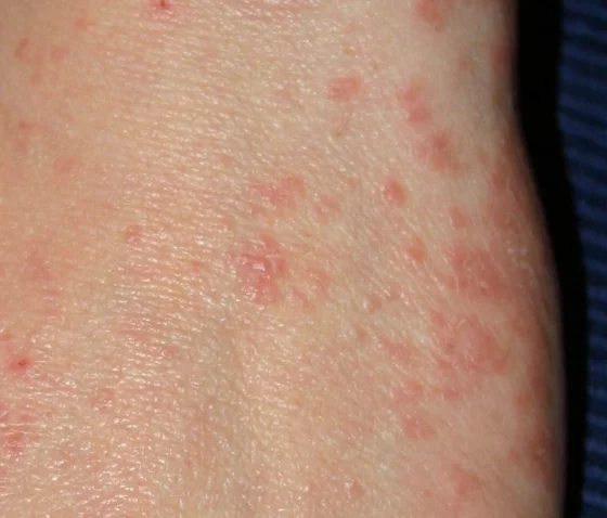 Korosta Likuvannya Diagnostika Profilaktika Simptomi 560x478 1